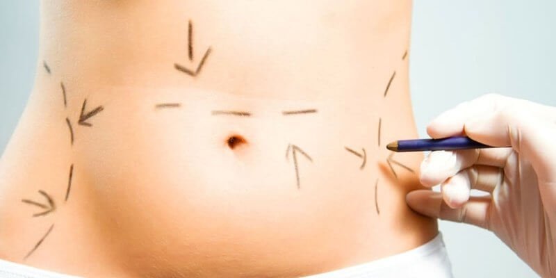 Liposuction Operasyonu Nasıl Uygulanır?