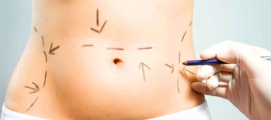 Liposuction Operasyonu Nasıl Uygulanır?
